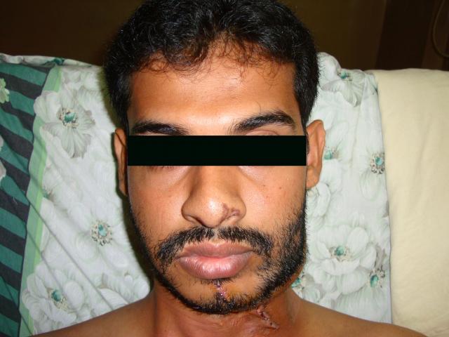 1st post op picture
